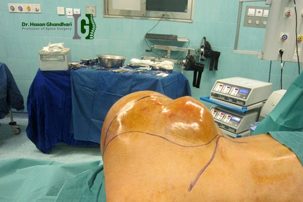 توموری که زندگی بیمار را مختل کرده بود