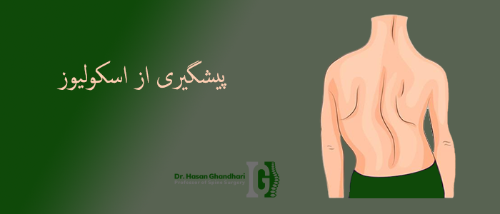 پیشگیری از اسکولیوز