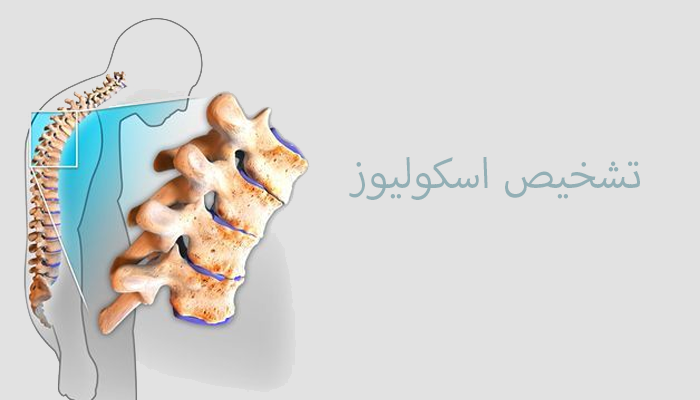 تشخیص اسکولیوز