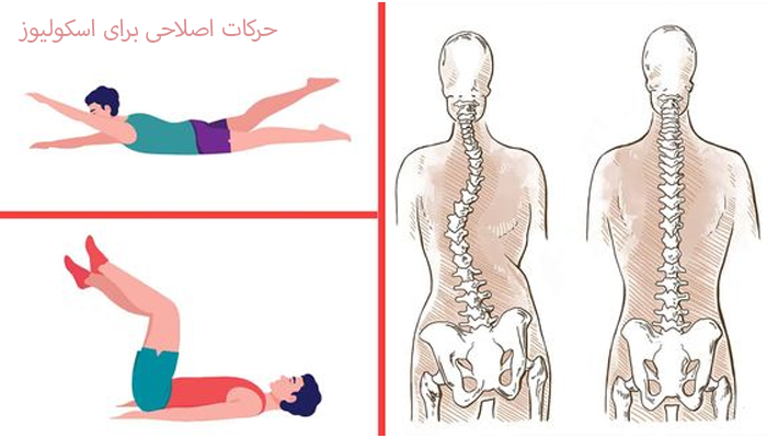 حرکات اصلاحی برای اسکولیوز