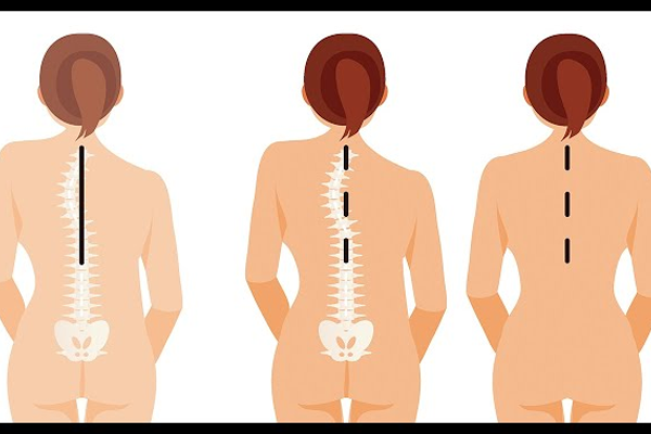 دلایل ایجاد اسکولیوز