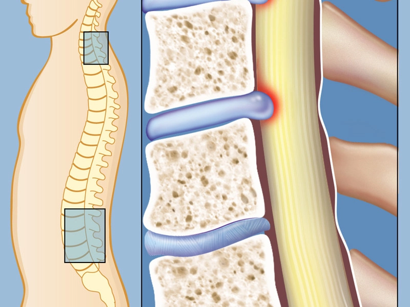 علل تنگی کانال نخاعی و نحوه تشخیص آن