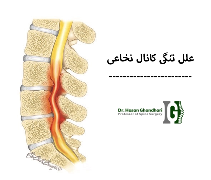 علل تنگی کانال نخاعی
