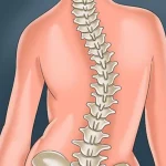 آیا اسکولیوز یا کیفوز باعث فلج شدن میشود؟