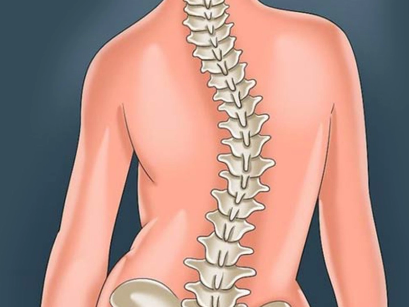 آیا اسکولیوز یا کیفوز باعث فلج شدن میشود؟