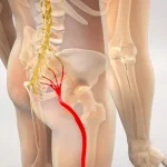 به چه علت رگ سیاتیک میگیرد؟ 