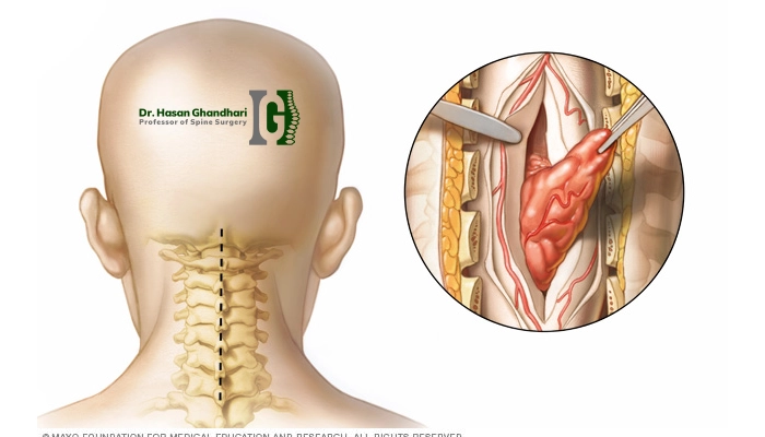 متخصص برای درمان تومورهای ستون فقرات