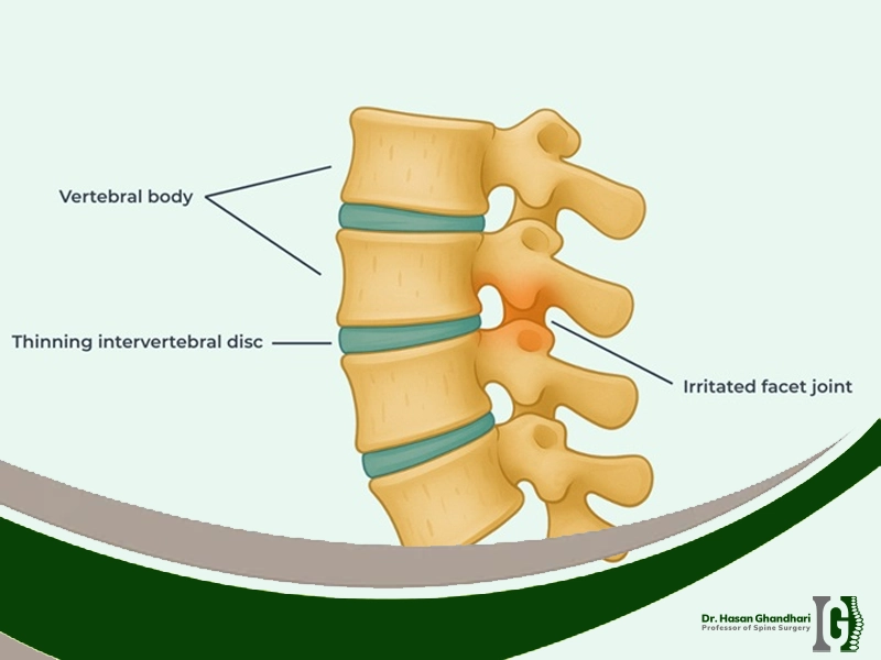 فاست در ستون فقرات